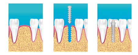 implant dentaire La Ferté sous Jouarre